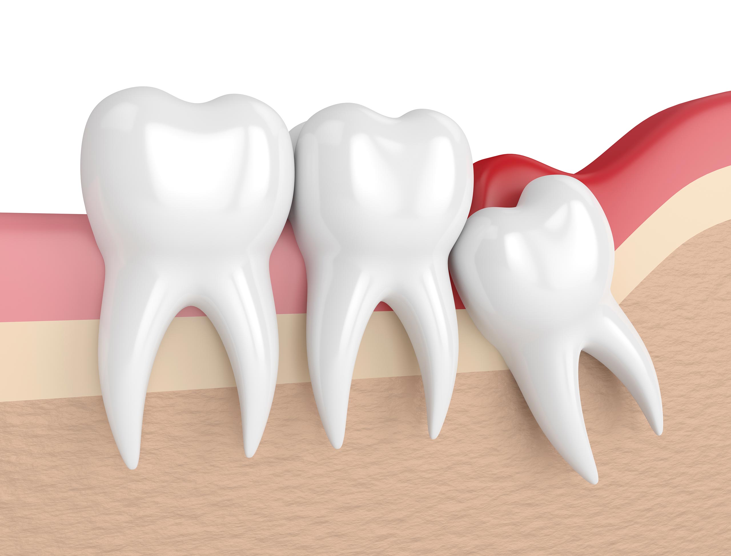 Impacted Tooth Removal