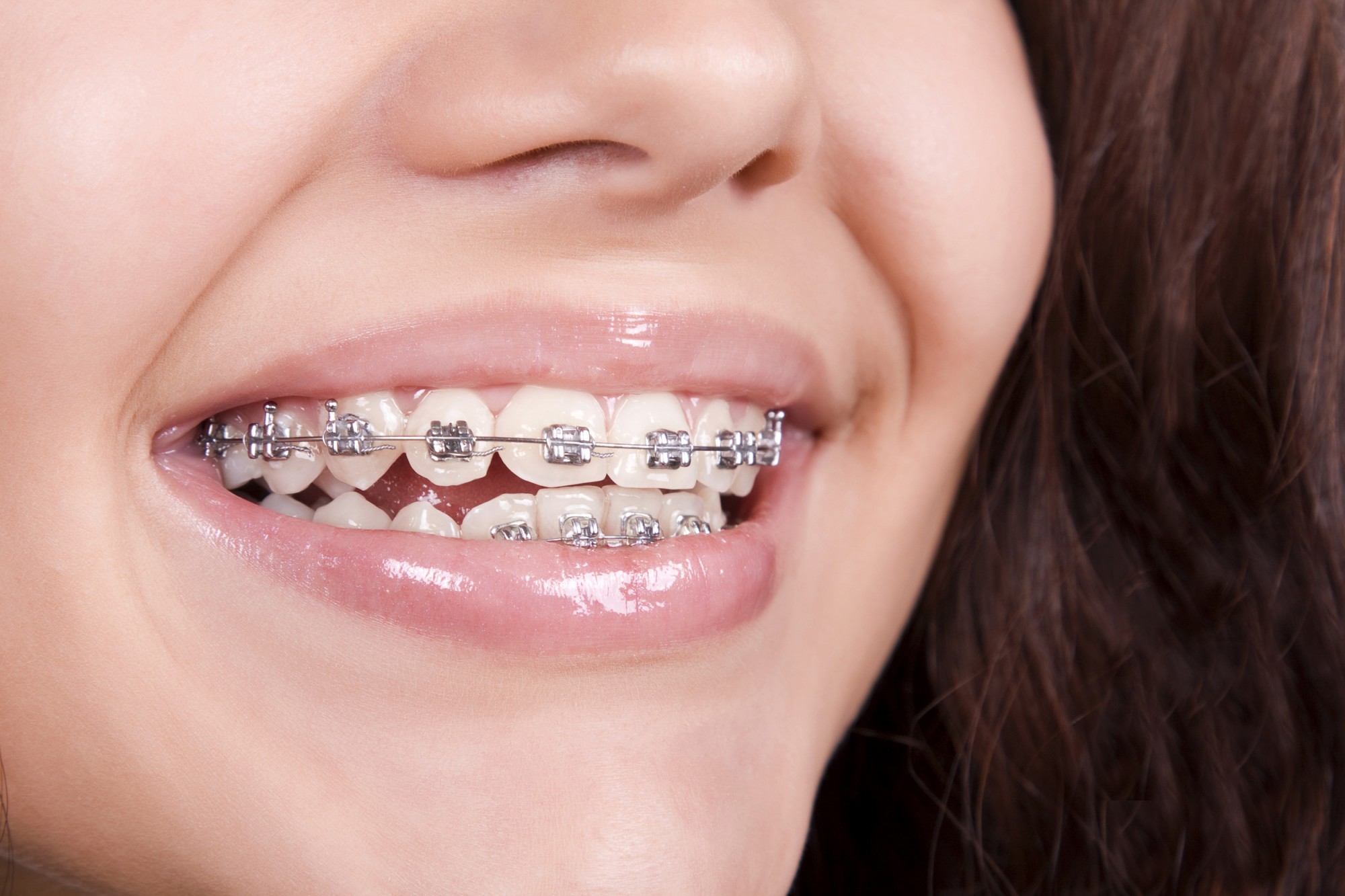 Dental Braces Treatment