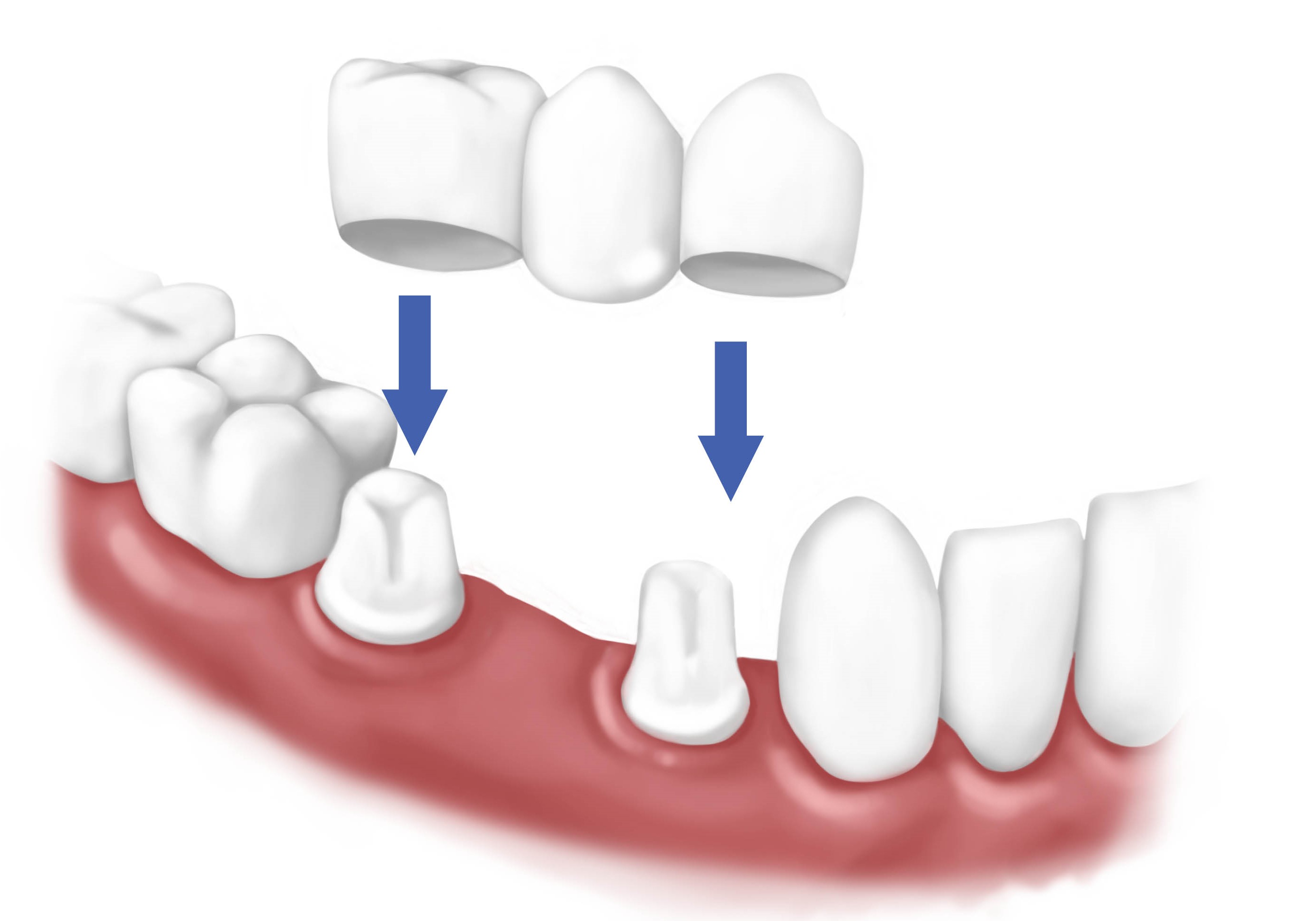 Dental Bridges