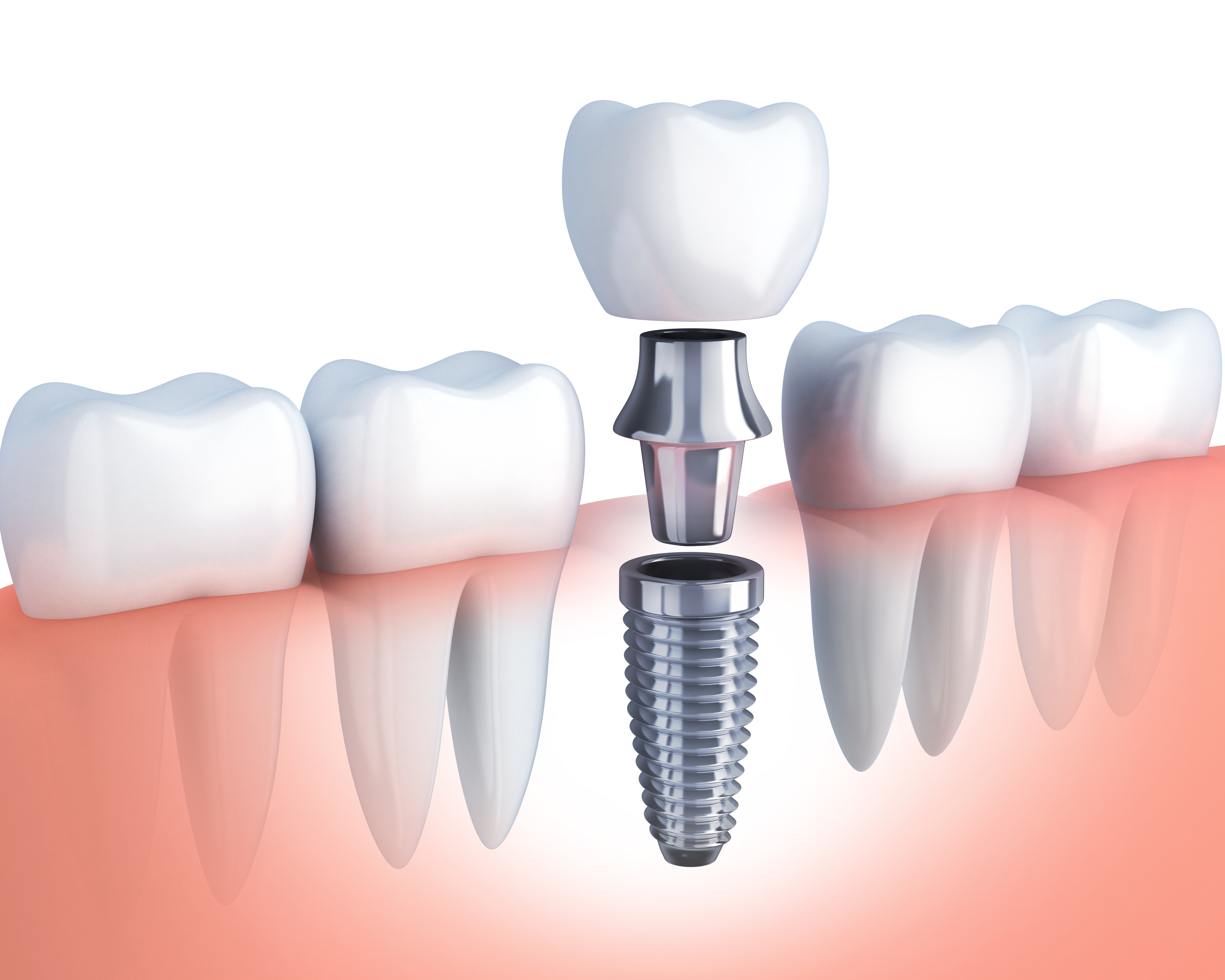 Fixed Teeth Replacement