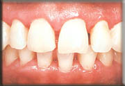 Non surgical treatments for gum disease