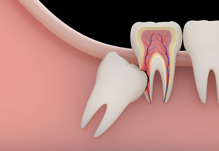 Tooth Removal