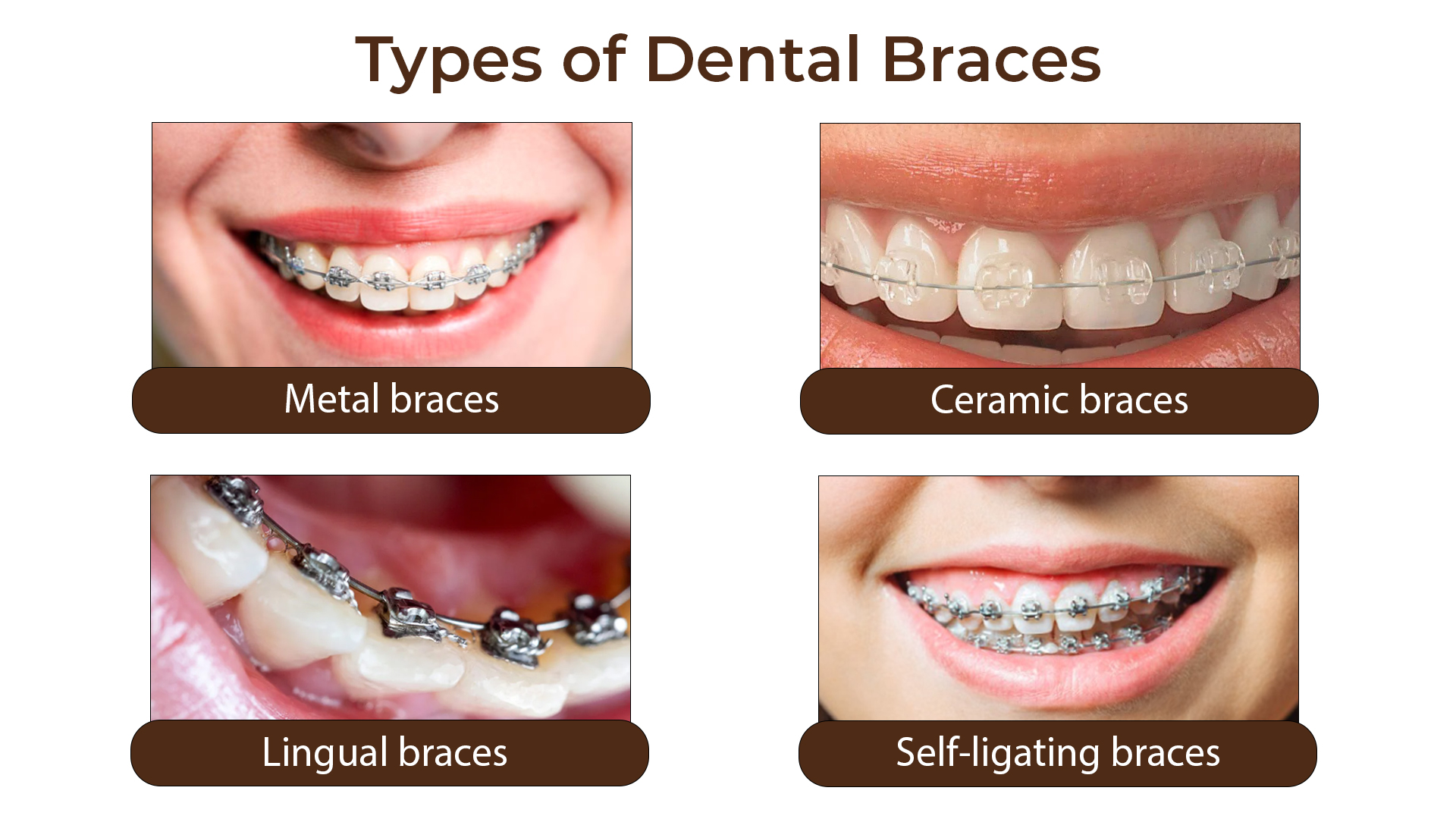 Braces Treatment in Delhi