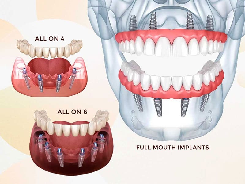 Dental-Implants
