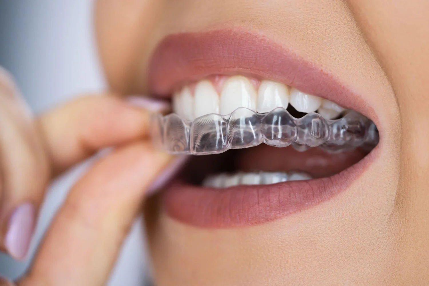 Invisalign Clinic in West Patel Nagar