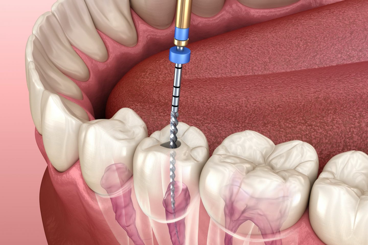 root-canal-treatment-delhi