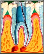 root canals